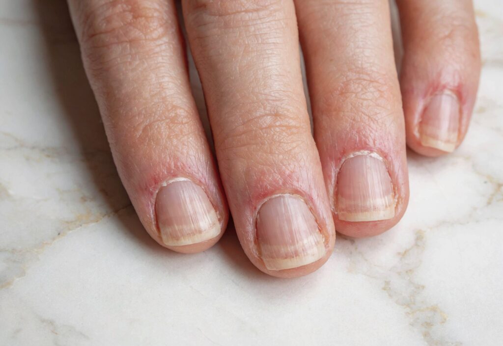 Thin weak natural nails after acrylic removal showing why you need to strengthen nails after acrylics